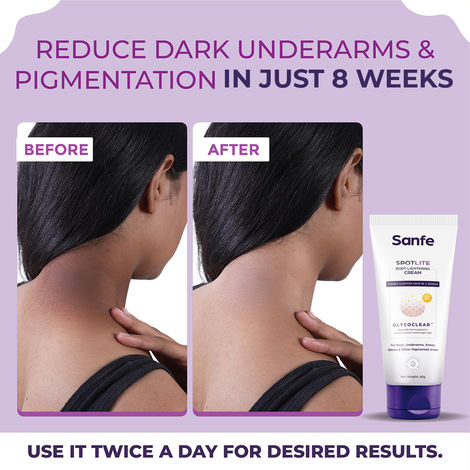 Dark neck removal shop cream
