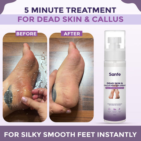 Sanfe Dead Skin Callus Remover Spray with Urea, Lactic Acid