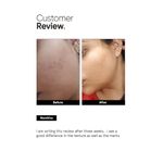 Buy Minimalist 32% Face Peel AHA 25% + PHA 5% + BHA 2% Peeling Solution for Glowing Skin, Smooth Texture & Pore Cleansing , 30 ml - Purplle