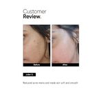 Buy Minimalist 2% Salicylic Acid Face Serum For Acne, Blackheads & Open Pores, 30 ml - Purplle