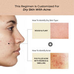 Buy Vedix Customized Skin Care Kit For Dry Skin With Acne - 3 Product Kit  - Vedix Face Wash For Dry Skin (100ml) - Vedix Face Serum For Acne (20ml) - Vedix Moisturizing Face Cream For Dry Skin (40ml) - Purplle