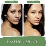 Buy Mystiq Living Specials - Green Tea Clarity - Acne Gel Cream | Anti Acne, Pimple & Scar Removal moisturizer, Skin Clarifying Day & Night Gel | Green Tea, Chamomile & Tea Tree | Oily & Acne Prone Skin , 50GM - Purplle