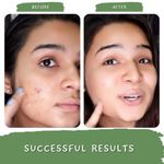 Buy Mystiq Living Specials - Acne Face Pack - Green Tea Clarity | Neem, Tulsi, Manjishtha & Green Tea | Acne Marks, Pimples, Zits, DeTan and Glowing Skin | Oily & Acne Prone Skin - 100 GM - Purplle