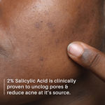 Buy DERMDOC 2% Salicylic Acid Face Serum (30 ml) | For Blackheads & Whiteheads | Targets Active Acne | Calms Irritation & Unclogs Pores - Purplle