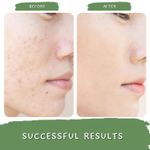 Buy Mystiq Living Anti Pigmentation Cream, Anti Blemishes Cream, Niacinamide And Kojic Acid Night Cream Green Coffee Day & Night Cream (50 gm) Dark Spots Removal Night Cream For Women & Men - Purplle