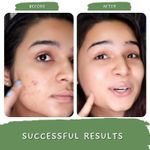 Buy Mystiq Living Acne Face Mask Green Tea Clarity (100 GM) Tan Removal, Face Mask, Anti Acne, De Tan, Acne Marks, Pimples, Oily & Acne Prone Skin and Glowing Skin | D Tan Pack Ayurvedic Formulation | Neem, Tulsi & Green Tea, For Women & Men 100 gm - Purplle