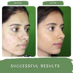 Buy Mystiq Living Anti Acne Gel Green Tea Clarity Acne Gel Cream (50 GM) Oily Skin Moisturiser, Pimple & Scar Removal, Skin Clarifying Day & Night Gel With Salicyclic Acid Tea Tree, For Women & Men - Purplle