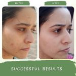 Buy Mystiq Living Tan Removal Face Pack Green Coffee Blemish Clear Face Mask (100 GM) with Kojic Acid, Anti Pigmentation, Dark Spot Removal, De Tan, Skin Brightening & Glowing Skin For Women & Men - Purplle