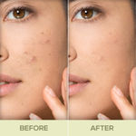 Buy RENEE Acne Filter 15gm, Enriched with Niacinamide & Salicylic, Unclogs Pores, Reduces Excess Oil, Acne & Blemishes, Fights Inflammation & Redness, Non Greasy Pimple Spot Corrector for All Skin Types - Purplle