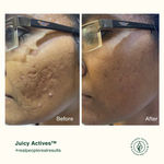 Buy Juicy Chemistry Anti Acne Kit Combo of 4 - Purplle