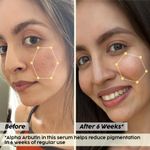 Buy PLIX 2% Alpha Arbutin Pineapple De-Pigmentation Dewy Face Serum for pigmentation & dark spots removal | For women & men with 10% Niacinamide, 5% PHA | Brighter, even-toned skin | 30 ml - Purplle