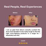 Buy Saturn By GHC Ultimate Acne Care Regime 3 Pcs - Purplle
