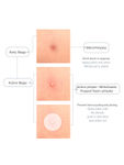Buy PRIVEDA Acne pimple patch 57 - 57 Pcs - Purplle