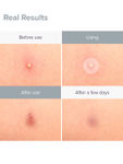 Buy PRIVEDA Acne pimple patch 57 - 57 Pcs - Purplle