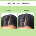 Buy Alps Goodness Aloe Vera, Hyaluronic Acid & Ketoconazole Anti Dandruff Scalp Serum For Dry Scalp (30 ml) - Purplle