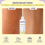 Buy Sanfe Calamine & Cica Body Lotion | For Itching, Irritation, Redness, Dryness | Rapid Relief For Hypersensitive skin | For Men & Women - 200 ml - Purplle