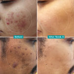 Buy Pilgrim 10% Niacinamide Face Serum For Acne Marks (10 Ml) - Purplle