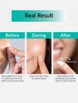 Buy Priveda Seoul Spot Clearing Acne pimple patch - Invisible Facial Stickers cover with 100% Hydrocolloid (57 patches) (20 gm) - Purplle