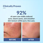 Buy Fixderma Acne Face Pack with Aloe Vera Gel | Neem Face Pack | Aloevera Gel for Skin | | Anti Acne Cream | Face Pack for Women | Treatment for Acne Prone Skin - 50 gm - Purplle