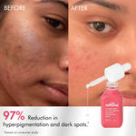 Buy mCaffeine CLEAR GLOW 3% Tranexamic, 2% Alpha Arbutin Advanced Pigmentation Serum Treatment For Melasma, Dark Spots, Scars & Evens Skin Tone Non-Sticky & Absorbs Fast | For Men & Women - 20 ml - Purplle