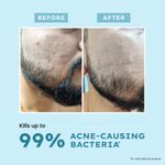 Buy Hyphen Acne Fix Spot Corrector with Salicylic & Azelaic Acid - Shrinks Active Acne & Prevents Pimple,15 gm - Purplle