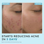 Buy HyphenA Acne Defence Daily Serum with 2% Salicylic Acid ,10% Azelaic Acid & 4% Niacinamide|Anti Acne & Pimples Face Serum- 30 ml - Purplle