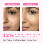Buy Hyphen Advanced De-Pigmentation Serum For Hyperpigmentation, Melasma, Dark Spots & Scars With 3% Tranexamic Acid & 2% Kojic Acid - 30 ml - Purplle