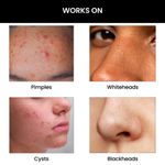 Buy ThriveCo Goodbye Acne Serum, 30 ml - Purplle