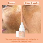 Buy WishCare Super Bright C16 Vitamin C Face Serum - Niacinamide, Kojic Acid & 4-n-BR - For Pigmentation - 30 ml - Purplle