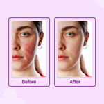 Buy The Derma Co. Hypochlorous Anti-Acne Hydrating Spray_200 ml Relief Acne & Eczema | Reduces Redness & Irritation | Promotes Healthy Skin | Anti-microbial & Anti-inflammatory | Alcohol & Fragrance Free for Women & Men - Purplle