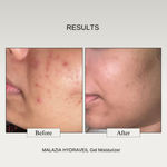 Buy The Formularx Hydra Veil 100% Oil Free Face Moisturizer (Malazia) for Oily, Acne Prone, Sensitive Skin 50 gm - Purplle