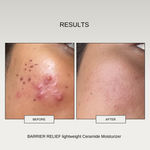 Buy The Formularx Ceramide Lightweight Face Moisturizer (Barrier Relief) for Normal, Oily, Acne prone, Combination, & Sensitive Skin 50 gm - Purplle