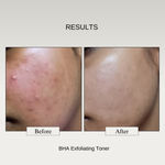 Buy The Formularx Exfoliating serum - 2% BHA (Salicylic Acid 2% & Niacinamide) for Acne, Blackheads & Reduces excess oil 100 ml - Purplle