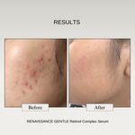 Buy The Formularx Gentle Retinol Anti-Aging Serum for acne, dark spots, enlarged pores, wrinkles 30 gm - Purplle