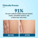 Buy Fixderma Strallium Stretch Mark Cream, Removes Pregnancy Stretch Marks, Scar Removal And Moisturizing Cream, Stretch Mark Remover For Stomach, Thighs & All Body Parts- 75 gm - Purplle
