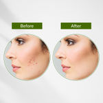 Buy Lotus Botanicals Neem, Tulsi & Salicylic Acid Anti-Acne Purifying Face Gel - 50 gm - Purplle