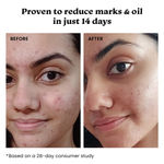 Buy Foxtale Oil Control Duo | 12% Niacinamide Clarifying Serum + Oil Balancing Moisturizer | Targets 7 Signs of Acne | Oil-Free Glow, Smoother Texture | With Azelaic Acid, Niacinamide & Cica - 80 ml - Purplle