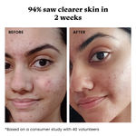Buy Foxtale Clear Skin Trio | Acne Cleanser + 12% Niacinamide Serum + Oil Balancing Moisturizer | Reduces Acne, Blemishes & Oil in 14 Days | With Salicylic Acid, Azelaic Acid & Cica - 180 ml - Purplle