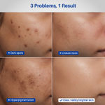 Buy DermDoc 2% Kojic Acid Face Serum | Dark Spots & Pigmentation Control | Brightening, Even-Tone Formula with Niacinamide + Alpha Arbutin + Glutathione | Spot Corrector Serum for Acne Marks, Tanning & Uneven Skin Tone – 20 ml - Purplle