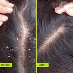 Buy PLIX Neem Anti-Dandruff Advanced Hair Oil | Reduces Dandruff | Soothes Itchy Scalp | Calms Inflammation | Non-Greasy & Lightweight | Dermatogically Tested |100 ml - Purplle