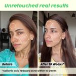 Buy PLIX Jamun Salicylic Acid Cleanser Gel For Active Acne | Acne Prone Skin 90 ml - Purplle