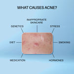 Buy DERMDOC 2% Salicylic Acid Face Wash (120 ml) | Oily, Sensitive & Acne Prone Skin Friendly | Clears Pimples, Dark Spots, Whiteheads & Blackheads | Gentle Exfoliation - Purplle