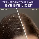 Buy Sanfe anti lice & dandruff shampoo | lice shampoo | kills super lice | detects & prevents infestation | no parabens, sulfates or dyes | with tea tree oil & eucalyptus | for kids & adults | 100 ml - Purplle