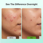 Buy Good Vibes Acne Clear Pimple Patch | Hydrocolloid Patches for Acne & Pimples | Cica, Neem & Salicylic Acid | Absorbs Pus & Oil | Reduces Redness, Shrinks Pimples Fast | Overnight Spot Treatment for Face – 36 Patches - Purplle