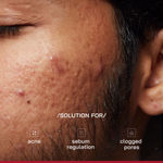 Buy Proven Honest Derma (PHD) 2% Salicylic Acid Anti-Acne Serum - 30 ml - Purplle