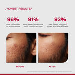 Buy Proven Honest Derma (PHD) 2% Salicylic Acid Anti-Acne Serum - 30 ml - Purplle