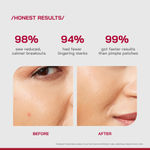 Buy Proven Honest Derma (PHD) Salicylic Acid Acne Spot Treatment Gel - 10 gm - Purplle