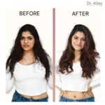 Buy Dr.Alies Professional Anti Dandruff Shampoo | Up to 100% Dandruff Reduction with Salicylic Acid (2%), Biotin, Aloe Vera & Tea Tree Oil | Flaky & Itchy Scalp Treatment | For Men & Women (250 ml) - Purplle