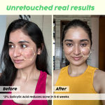 Buy PLIX Jamun Acne Spot Corrector Gel For Reducing Active Acne | Day & Night Gel | Controls Oil & Soothes Inflammation | For Men & Women | 15 gm - Purplle