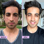 Buy PLIX Jamun Active Acne Mini Facewash Gel Oily & Acne Prone Skin | Daily Use | Women & Men | 50 ml - Purplle